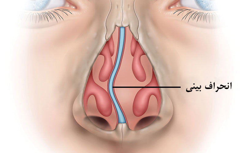 جراحی انحراف بینی